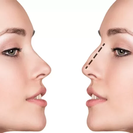 Quels sont les résultats attendus d’une rhinoplastie combinée avec une autre procédure par Dr MARTIN ?