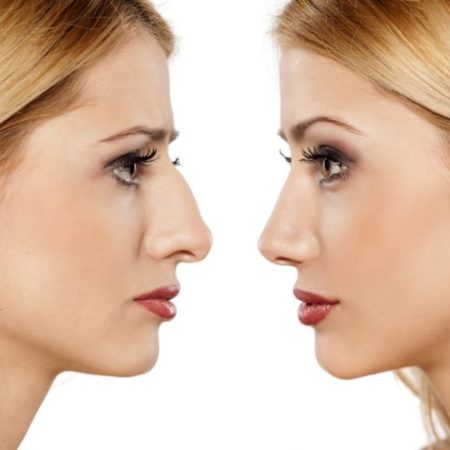 Comment la rhinoplastie à Lyon peut-elle influencer la qualité de vie des patients ?