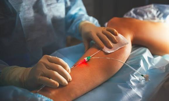 Laser varices